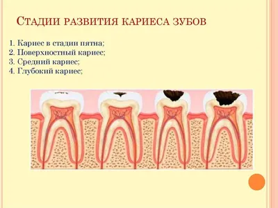 Как выглядит кариес, стадии кариеса белое пятно