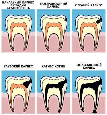 Лечение кариеса в Москве | Стоматология Denta