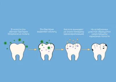 Пришеечный кариес фото, как лечить, причины возникновения | Dental Art