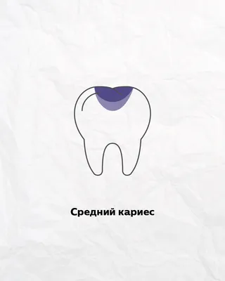 Кариес 1 Зуба Больно Ли Вылечить Удалять Убрать ЛюмиДент