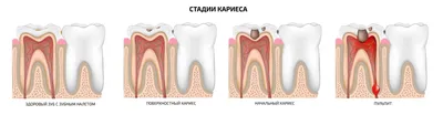 Скрытый кариес: симптомы, причины, лечение, профилактика, фото скрытого  кариеса, цены в Москве