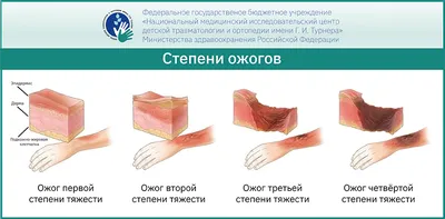 Рубцовые последствия ожогов – уникальные комплексные методики лечения  последствий ожогов у детей в ФГБУ «НМИЦ детской травматологии и ортопедии  им. Г. И. Турнера» Минздрава России -