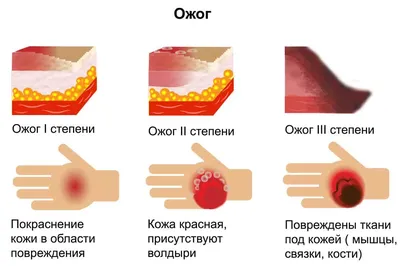 Химический ожог: первая помощь, лечение, классификация