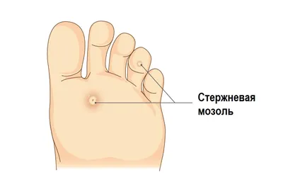 Стержневая мозоль! | Центр подологии в Курске | Дзен