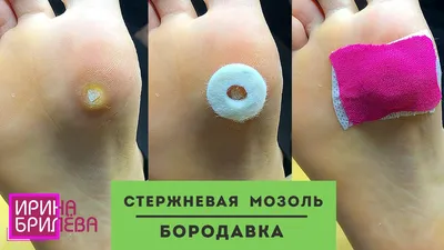 Удаление стержневой мозоли в Красногорске - цена на лечение сухой мозоли