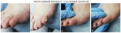 Nail master - Стержневая мозоль. Такая маленькая , но... | Facebook