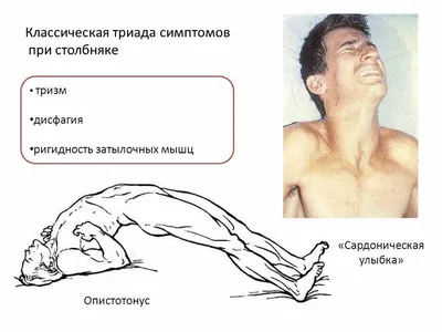 Столбняк (справочник невролога)