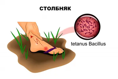 Столбняк - причины появления, симптомы заболевания, диагностика и способы  лечения