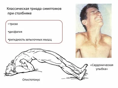 Заражение столбняком. Профилактика - Береги себя для жизни - 39-я городская  клиническая поликлиника