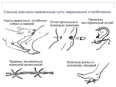 Профилактика столбняка - Как уберечь себя и наших близких от инфекционных  заболеваний - УЗ \"16-я городская поликлиника\"