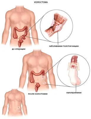 Колостомия - виды, показания к наложению стомы