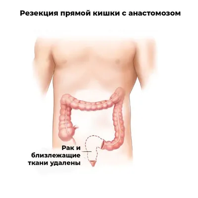 История пациентки: стома