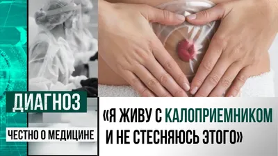 Что делать, если у вас пролапс кишечной стомы?