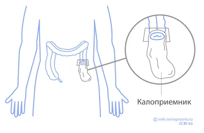 Тест: как ухаживать за пациентом с кишечной стомой — Про Паллиатив