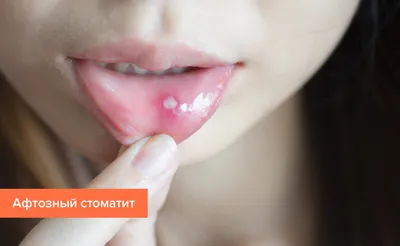 Стоматит у детей: виды и лечение | Healthy Dent (Киев)