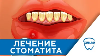 Стоматит 9 Фото Чем Лечить На Языке Десне ЛюмиДент