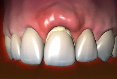 Осложнения после несъемного протезирования зубов в стоматологии