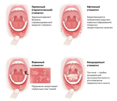 Стоматит во рту фото