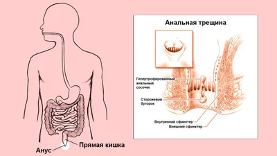 Анальная трещина: что это, симптомы, причины, лечение трещин в заднем  проходе, профилактика