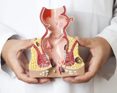 Трещина прямой кишки - презентация онлайн