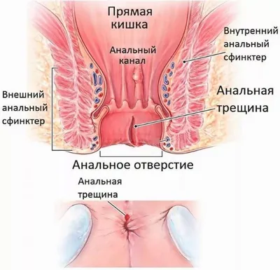 Анальная трещина — причины, симптомы и лечение заболевания