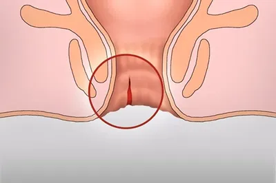Анальная бахромка заднего прохода (перианальные складки): симптомы, лечение  и диагностика
