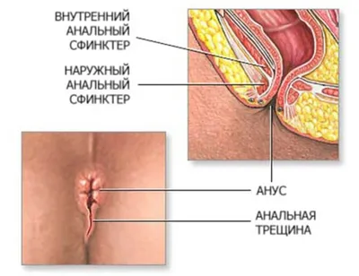 Анальная трещина. Методика лечения | SBS-MED