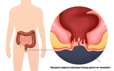 Лечение анальных трещин в Ростове-на-Дону - клиника Doctor-Prof