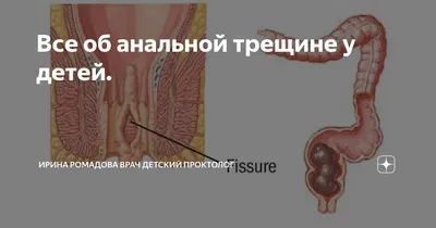 Анальная трещина: что это, симптомы, причины, лечение трещин в заднем  проходе, профилактика