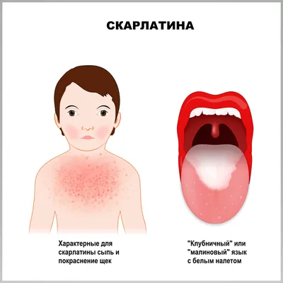 Стрептококковая инфекция - причины появления, симптомы заболевания,  диагностика и способы лечения