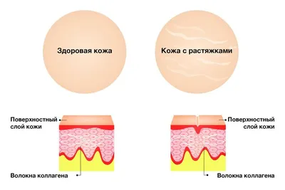 Центр эстетической гинекологии - 👉Растяжки ( стрии) - это кожный дефект в  виде линейных полос , возникающий в местах растяжения кожи. По сути-это  порванная кожа, зашитая соединительной тканью. Они имеют розовый или