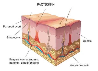 Фиолетовые растяжки – лечение в медцентре «Номосклиник» | Стоимость  процедуры в Москве, отзывы, вопросы и ответы