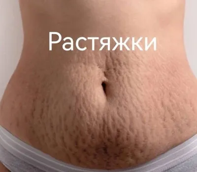 О стриях (растяжках)