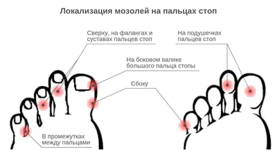 Стержневая мозоль: причины появления | Leo Beauty | Центр Подологии. Москва  | Дзен