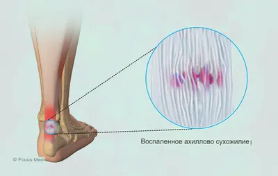 Тендинит сухожилия задней большеберцовой мышцы — все о беге на Get.run