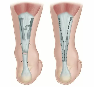 Реабилитация после разрыва ахиллова сухожилия - KinesioPro