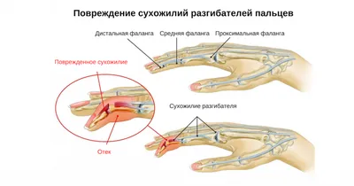 до и после. женщина, страдающая от пятен. воспламенение или растяжение  сухожилия в горсине ноги. концепция Стоковое Фото - изображение  насчитывающей фасция, рука: 274953924