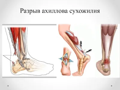 Травмы большого пальца ноги: диагностика и лечение — все о беге на Get.run