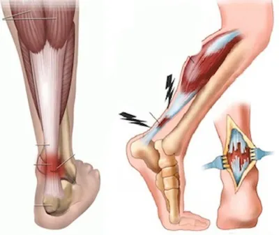 Разрыв ахиллова сухожилия - признаки, причины, симптомы, лечение и  профилактика - iDoctor.kz