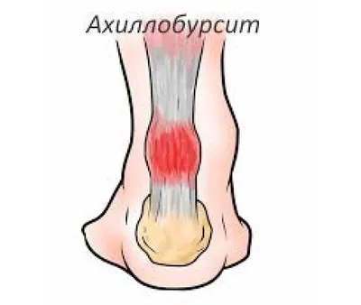 Болит ахиллово сухожилие при ходьбе: причины, симптомы и лечение боли над  пяткой