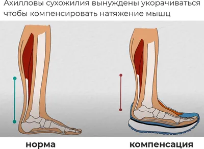 Убрать боль в суставах и сухожилиях. Тренировка Альфредсона для  восстановления Ахиллова сухожилия. | Фитнес тренер Юрий Спасокукоцкий | Дзен