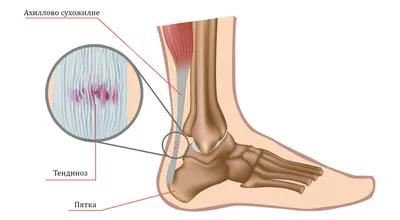 Бурсит ахиллова сухожилия - признаки, причины, симптомы, лечение и  профилактика - iDoctor.kz