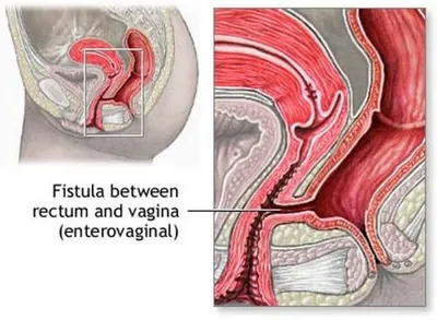 Ректовагинальный свищ — причины, симптомы, лечение заболевания