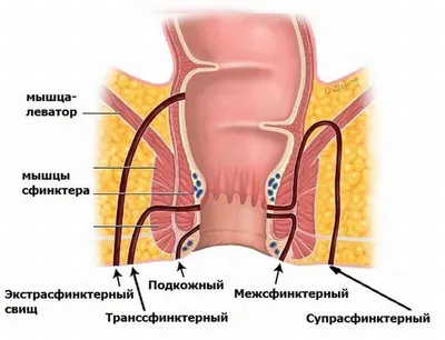 Свищ толстой кишки — surgery-first.ru