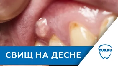 Свищ на десне - что это такое, от чего появляется и как его вылечить -  Denta Care Clinic