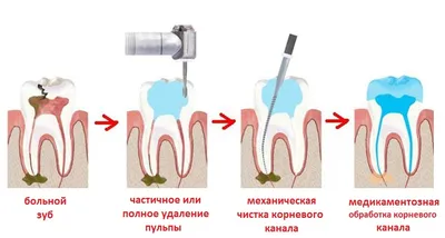 Свищ на десне: причины возникновения, как выглядит, что делать и как лечить