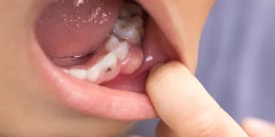 Свищ на десне у ребенка: фото, лечение, что делать | Dental Art