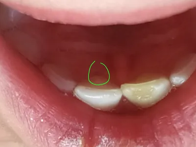 Свищ молочного зуба | Детская и семейная стоматологическая клиника \"Белая  Медведица\" | Санкт-Петербург