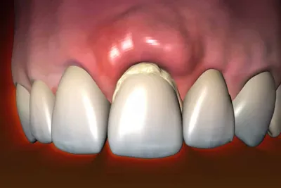 Шишка на десне после установки импланта - Полезные статьи на сайте  стоматологической клиники Церекон