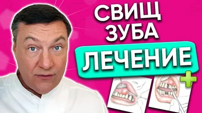 Свищ на десне лечение в домашних условиях. Свищ зуба как лечить? - YouTube